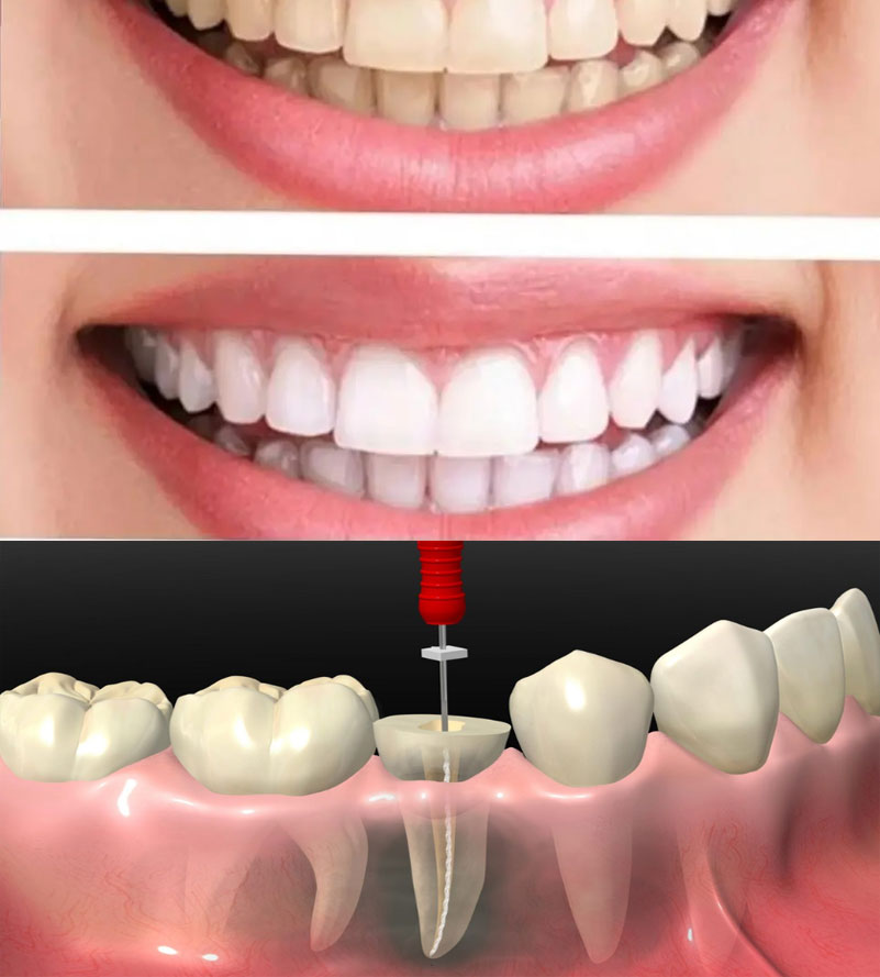 Dental Implant in Dahisar East- Smile 360 Dental Clinic